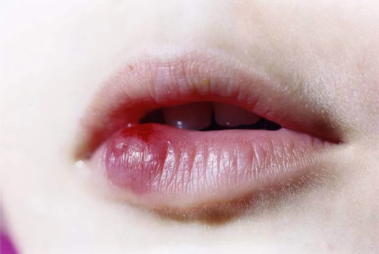Cách xử lý vết thương khi bị cắn vào môi